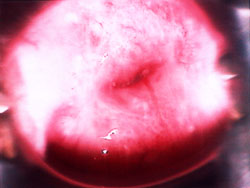 cervix in normal light