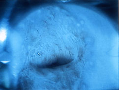 cervix under blue light to show abnormal blood vessle growth